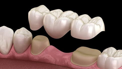 Bridges & Tooth Replacement