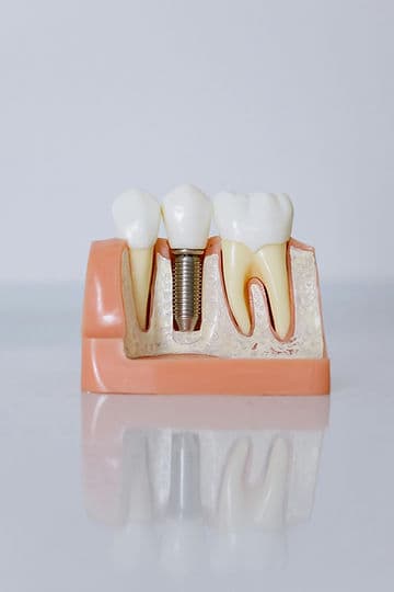 Dental Implants